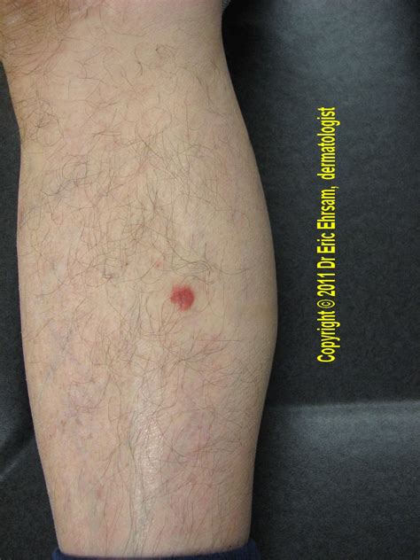 melanoma on thigh pictures